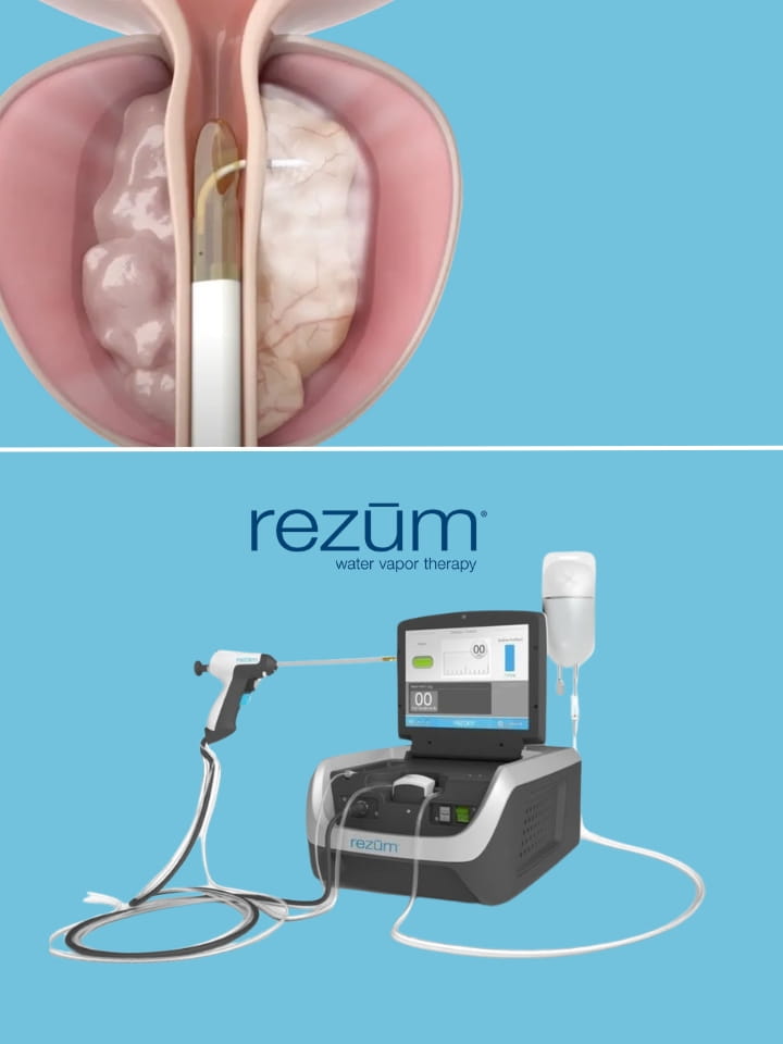 Rezum – Terapia con vapore acqueo per l'ipertrofia prostatica benigna